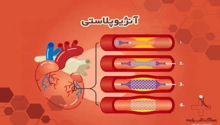 آنژیوپلاستی و روش انجام آن