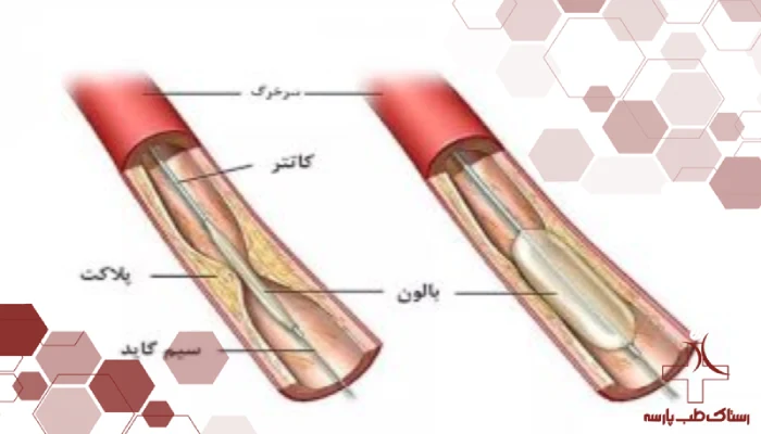 آنژیوپلاستی و شیوه استفاده از اینفلیتور در آن