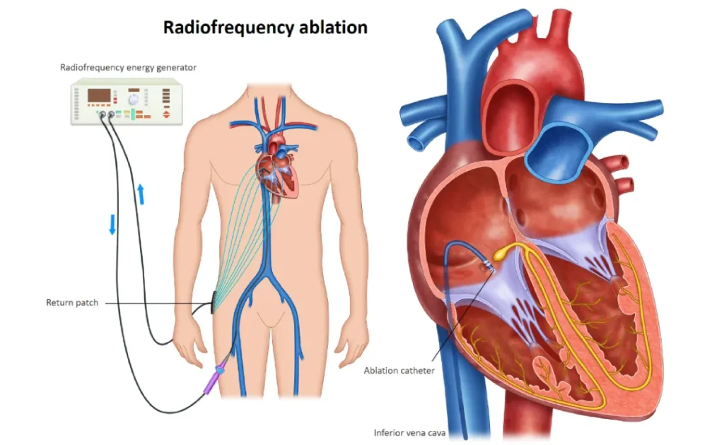 ابلیشن قلب (Ablation)