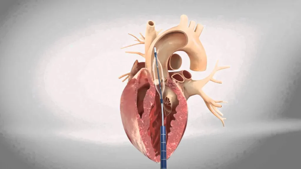 جراحی تعویض دریچه آئورت با کاتتر (TAVR)