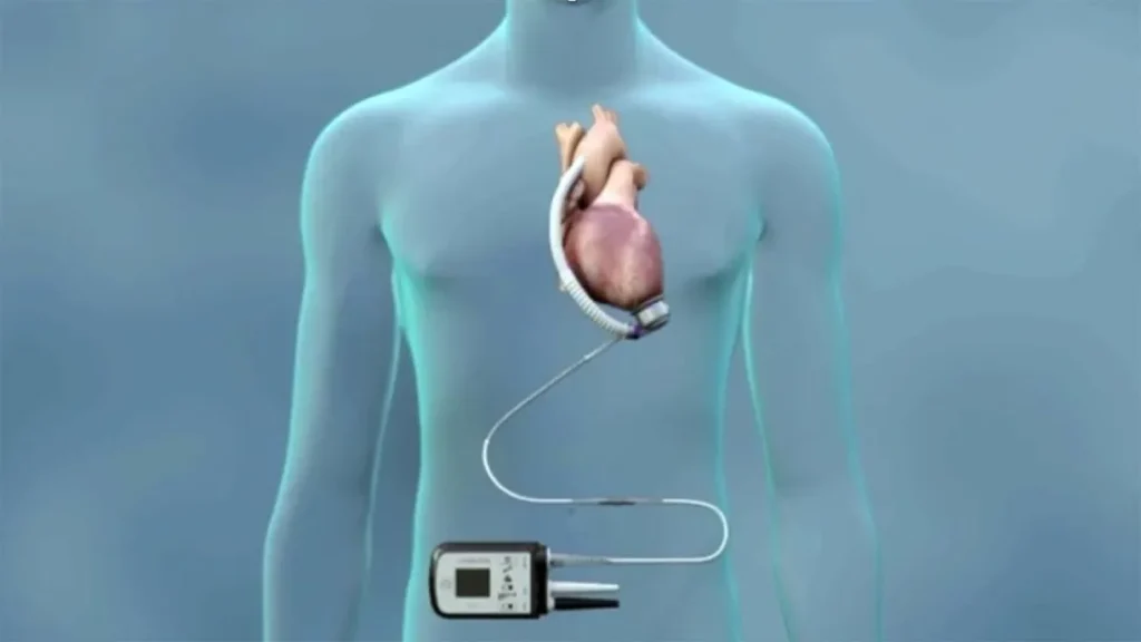 جراحی پیوند بطن چپ (LVAD)