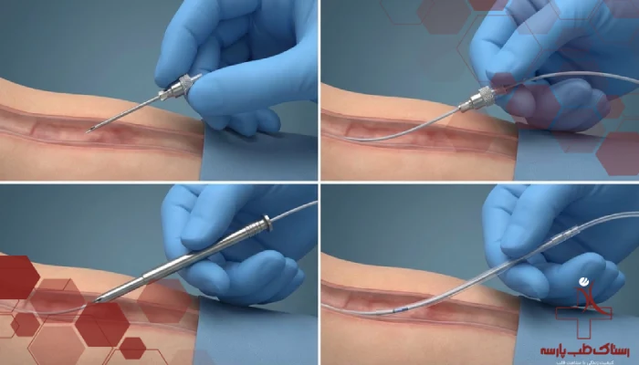 تصویر مرحلهبهمرحله تکنیک سلدینگر برای گذاشتن کاتتر