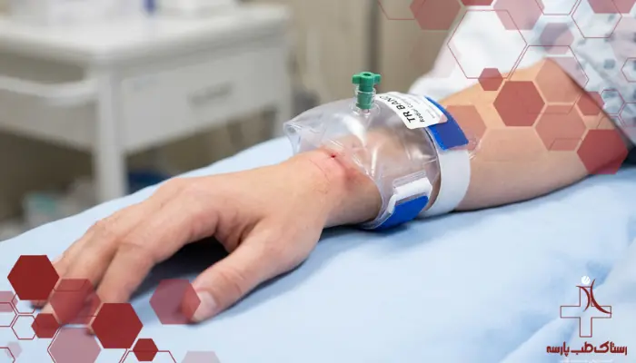 تی‌آر باند هوایی روی مچ دست پس از خروج دسیله رادیال